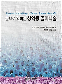 (눈으로 익히는) 상악동 골이식술=Eye-Catching Sinus Bone Graft